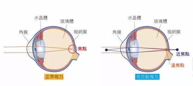 白內(nèi)障和老花眼區(qū)別，老花眼發(fā)病率正呈現(xiàn)年輕化趨勢