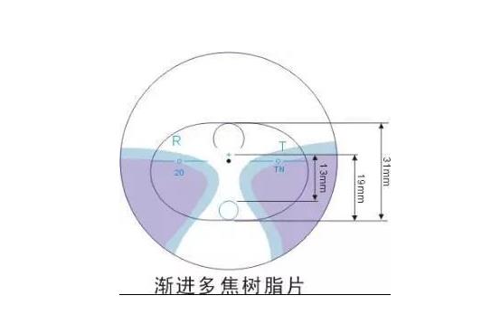 美麗島多焦鏡適合的人群，需要注意的事項(xiàng)